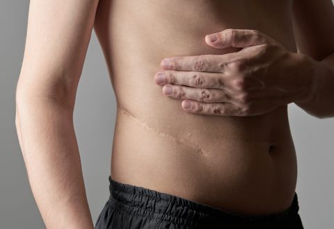 Can a Settlement Cover Scar Treatment Costs?